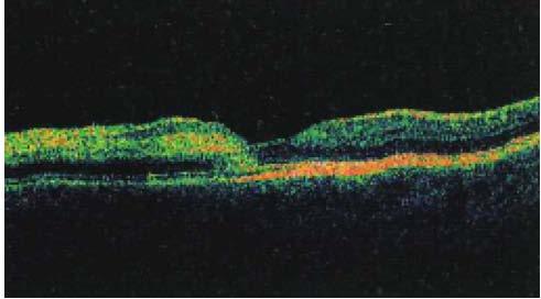 Později sítnice atrofuje. Za pomoci tohoto diagnostického přístroje je možné lézi rozpoznat včas.