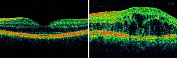 5.10 Diabetická retinopatie Diabetická retinopatie (DR), jmenovitě tedy diabetický makulární edém a komplikace proliferativní diabetické retinopatie v podobě hemoftalmu a trakčního odchlípení