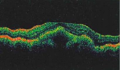 Další onemocnění diagnostikovaná pomocí OCT: 5.13 Viteliformní degenerace dospělých Toto hereditární onemocnění vzniká ve 3. až 4. dekádě života.