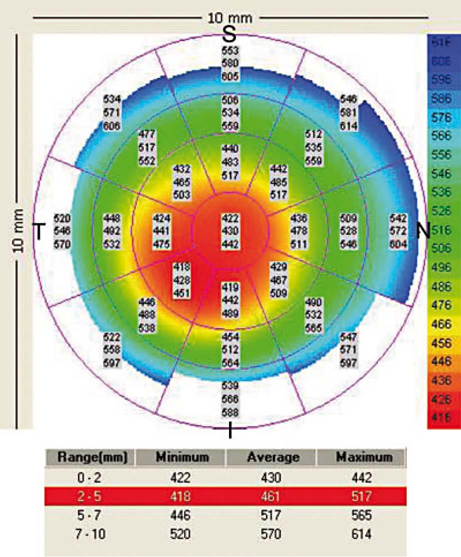 než 470 µm a rozdíl mezi hodnotou minimální a maximální tloušťky rohovky zápornější než - 100 µm.