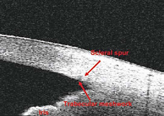 6-4 Obraz předněkomorového úhlu s vyznačením lokace sklerální spony