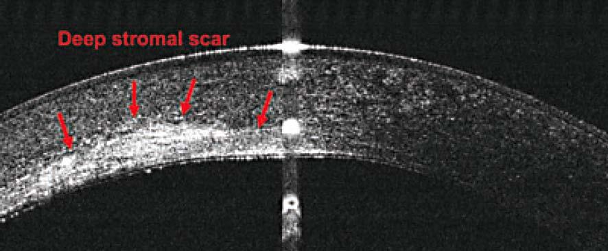 6.4 Abnormality rohovky a skléry Předně segmentová optická koherentní tomografie umožňuje kromě měření tloušťky rohovky také precizně mapovat hloubku jejího zakalení, stupeň epiteliální hyperplazie,