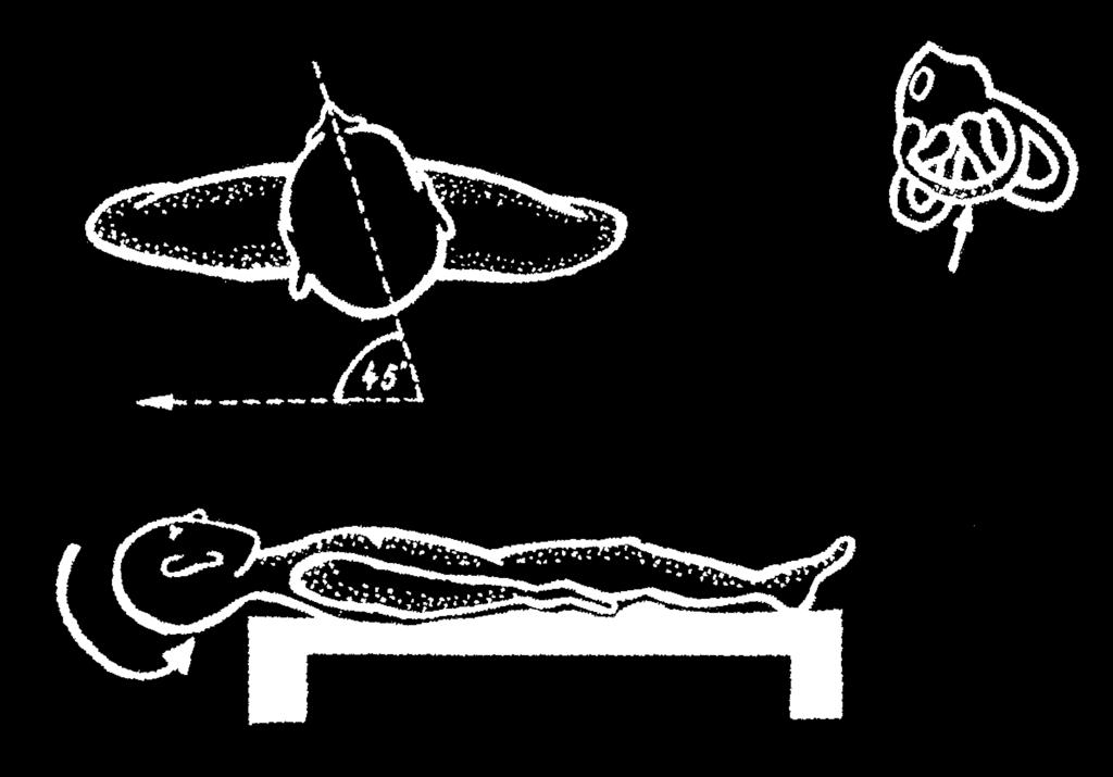 EPLEY-ův repoziční manévr (5 poloh) 1 2 Pacient volně sedí na loži.