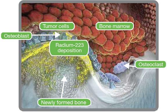 Alpharadin alfa zářič radium 223 chlorid kalcium mimevkum