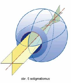 2. REFRAKČNÍ VADY Astigmatismus je refrakční vada, při které nemá optický systém oka ve všech meridiánech stejnou optickou mohutnost.