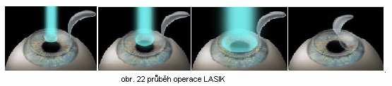 Při správné pozici a adhezi lamely může být operace ukončena. Bandážní kontaktní čočka nemusí být aplikována.
