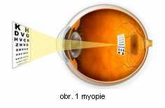 přichází do oka se sbíhají Podle počtu dioptrií můžeme myopii rozdělit na myopii lehkou (myopia simplex: do - 3 D), myopii střední (myopia modica: od -3,25 až -6D ) a na myopii těžkou (myopia gratis: