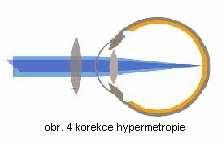 2. REFRAKČNÍ VADY Hypermetropie Každé dítě se rodí jako hypermetropické (dalekozraké), jak oko postupně roste, hypermetropie klesá, v pubertě má určitý stupeň hypermetropie přibližně 50% očí.