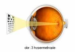 U hypermetropie se rovnoběžné paprsky vstupující do oka sbíhají v ohnisku za sítnicí a vzniká tak neostrý obraz. Člověk s hypermetropií má problémy při pohledu do blízka.