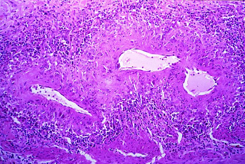 histologie radiologický obraz MR: v časném stadiu obsahuje plak mnoho buněk a je edematosní T2 Případy způsobené malignitou