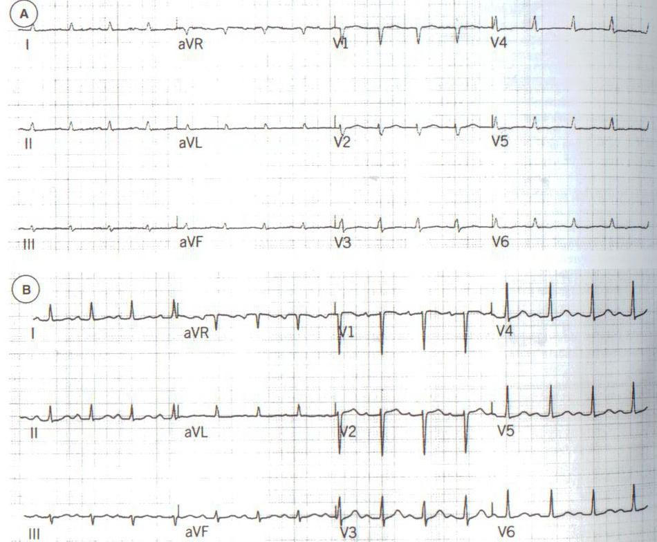 EKG u hypothyreózy Myxedém se srdečním