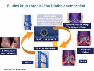 Příčiny a projevy chronického žilního onemocnění Základní faktory, které vedou k rozvoji chronického žilního onemocnění (CVD), jsou tři.