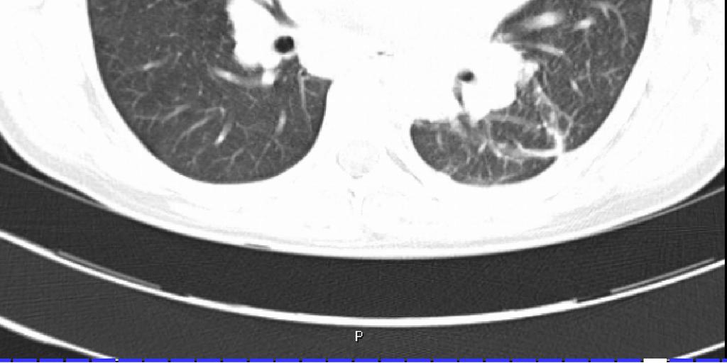 Obstrukční ventilační porucha bývá diagnostikována u nemocných s rozsáhlým endobronchiální postižením či fibrotickými změnami, bývá popisována spíše v počátečních fázích choroby (Harrison, 1991).