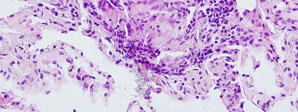 U nemocných s plicním postižením je doporučováno provedení transbronchiální biopsie (TBB) s odběrem více jak 4 vzorků, vhodné je toto vyšetření doplnit i biopsií bronchiální