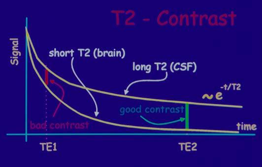 T2-vážený obraz (T2W)