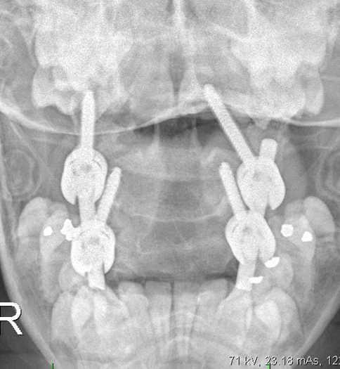 Operační léčba - konzervativně nereponibilní dislokace - nestabilita s neurologickým postižením nebo