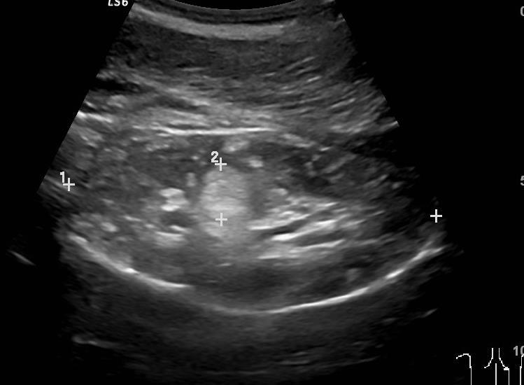 sarkom ze světlých buněk - do roku 1978 Wilmsův tu, metastázuje do kostí rhabdoidní tumor - metastázuje do CNS mezoblastický nefrom - je to