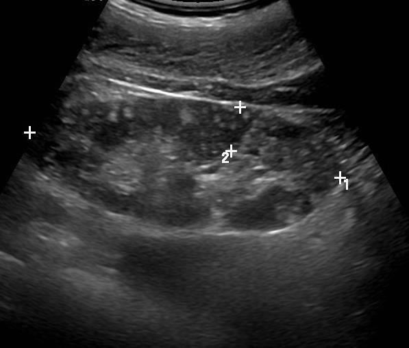 chemoterapii nebo radiační léčbě nebo u pacientů s tuberózní sklerózou. Vyskytuje se spíše ve 2.