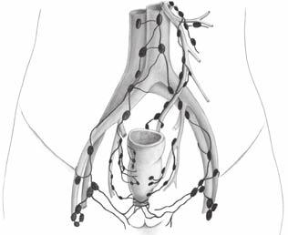 ? 14 Komplexní léčba nádorů rekta paraaortální uzliny aorta vasa mesenterica inf. vasa iliaca int. vasa iliaca ext. Obr. 2.4 Lymfatické šíření karcinomu rekta ganglií.