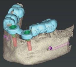 souběžné výroby provizorní protetiky Implantační šablona: Zvyšuje přesnost zákroku Umožňuje naplánovat a vyrobit perfektní