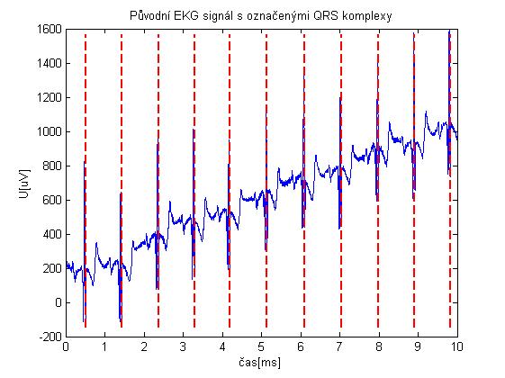 6-8 Původní EKG signál W001 s označenými QRS komplexy 6.5. Kombinace svodů Princip metody kombinace svodů bude ukázán na signálu W001 z třísvodové XYZ databáze CSE.