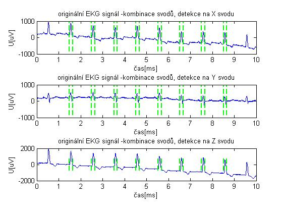 7-3 W017 Hranice QRS komplexu kombinace svodů shlukovou analýzou 7.2. P vlna První fází detekce P a také T vlny je úprava EKG signálu tak, aby v něm tyto složky byly zvýrazněny.