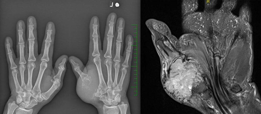 301 Obr. 1. Rtg (vlevo) a MRI (vpravo): metastáza světlobuněčného renálního karcinomu v záprstní kosti palce levé ruky Fig. 1. X-ray (left) and MRI (right): the metastasis of a clear cell renal cell carcinoma in the left thumb Z osobní anamnézy stojí za pozornost arteriální hypertenze, diabetes mellitus 2.