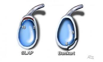 Obrázek č. 7.: SLAP a Bankartova léze (Zdroj: SMITHUIS et al. dostupné z http://www.radiologyassistant.nl/en/p4f49ef79818c2/shoulderanatomy.html#i4f4aa31754ff5.