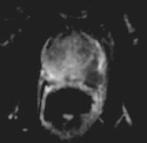 Protokol mp-mri Difúzně vážené zobrazení