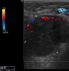 Pathological lymph node it is magnified, L/T index is less than 2, inhomogeneous appearance, hilar cortical blood flow, hilar effacement zitivní prediktivní hodnota 73% (11).