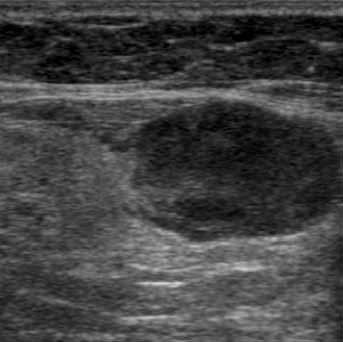 7. Core-needle biopsy of the lymph node, before sampling, the biopsy needle is advanced near to the lymph node Obr. 8.