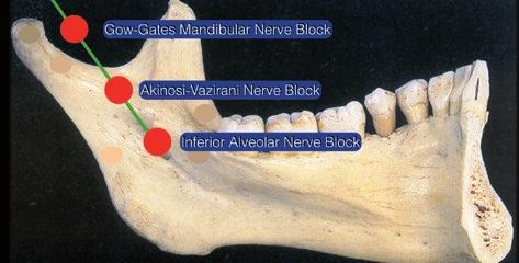 Tři výše popsané techniky poskytují (teoreticky) plné znecitlivění příslušného kvadrantu dolní čelisti, ve kterém jsou provedeny.