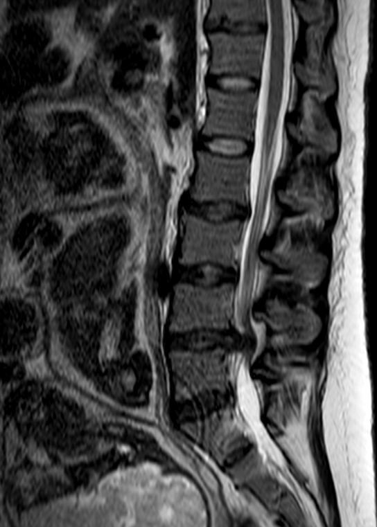 MR V GRAVIDITĚ Pacientka 29 let Gravidita 36 + 2 Syndrom kaudy equiny Rozsáhlá mediální herniace disku L4/5,