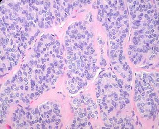 Nízce diferencovaný karcinom štítné žlázy Nízce diferencovaný karcinom leží na pomezí mezi dobře diferencovanými karcinomy (papilárním a folikulárním) a nediferencovaným karcinomem.