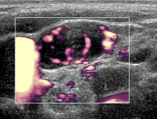 Granulomatózní lymfadenitidy TBC, sarkoidóza, zoonózy