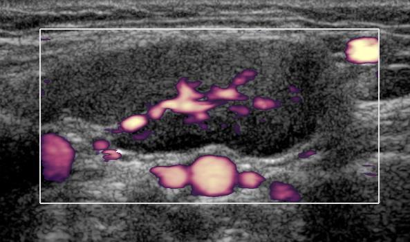 CEUS (contrast-enhanced