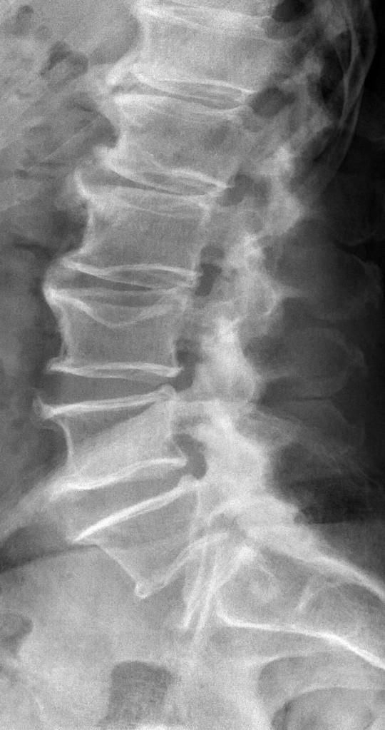 Spondylosis deformans