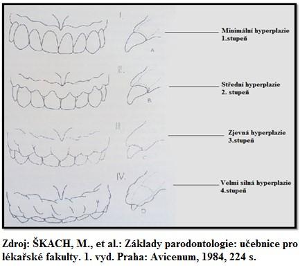 3. stupeň-zjevná hyperplazie, kde gingivální tkáň téměř překrývá klinickou korunku zubu. 4. stupeň-velmi silná hyperplazie spojená s poruchou funkce [53]. Obr. č. 6.