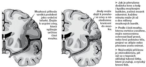 CESTA Z MLČENÍ 2.3 Prevence: Mezi ovlivnitelné rizikové faktory vzniku mrtvice patří vysoký krevní tlak, kouření, obezita a vysoká hladina cholesterolu či cukrovka.