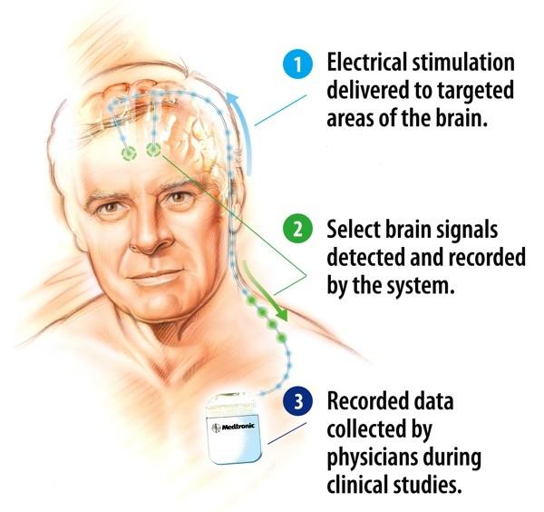 kabel, neurostimulátor Externí část - externí