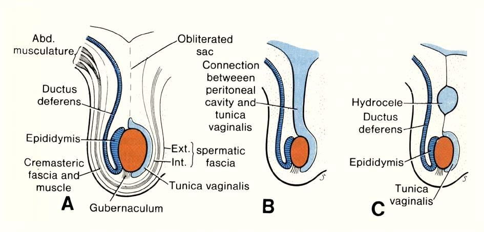 (A) obliterace procesus vaginalis peritonei normální, (B) perzistující