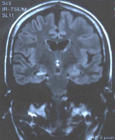 Hipokampální skleróza Histopatologický nález neuronální ztráta a gliová přestavba Anamnéza 1) Iniciální inzult před 4.