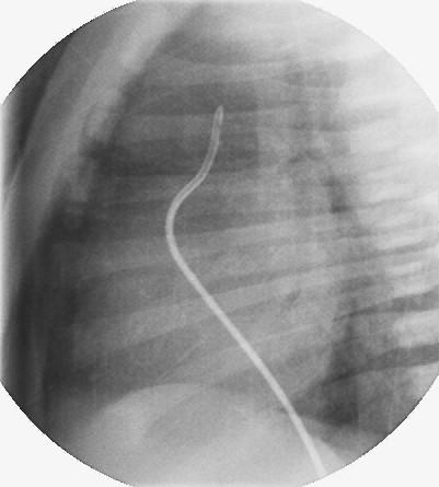 Angiokardiografie Neonatální COA +