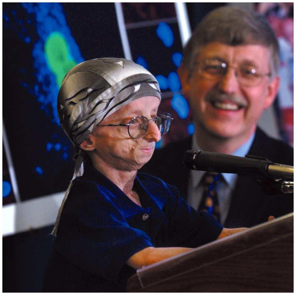 Progerie dědičná onemocnění typická předčasným stárnutím (např. Hutchinson-Gilfordův syndrom, Wernerův syndrom) příznaky - předčasná plešatost, vrásčitost, apod.