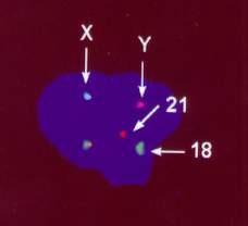 Diagnostika nejčastějších numerických chromosomálních aberací využitím fluorescenční in situ hybridizace (FISH): Preimplantační dg.