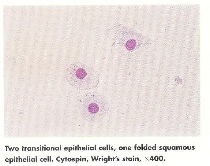 Buňky přechodného epitelu jedná se o buňky epitelární výstelky urinálního traktu močový měchýř a proximální část uretry u mužů. Buňky pocházející z hlubších vrstev jsou hustší a kulatější.