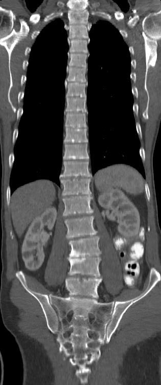 Uretery v norme. Močový mechúr: V norme. Črevo: Normálneho kalibru. Lumen je rovnomerne naplnený kontrastom, bez ložiskových lézií. Abdominálne a panvové LU: Bez zväčšených LU.