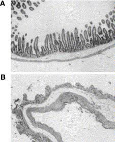 profága, který kóduje toxin Stx 2 charakteristický pro EHEC. Infekce EAHEC se vyznačuje gastroenteritidami a HUS (Biju a kol. 2012). Cell-detaching E. coli: Cell-detaching E.