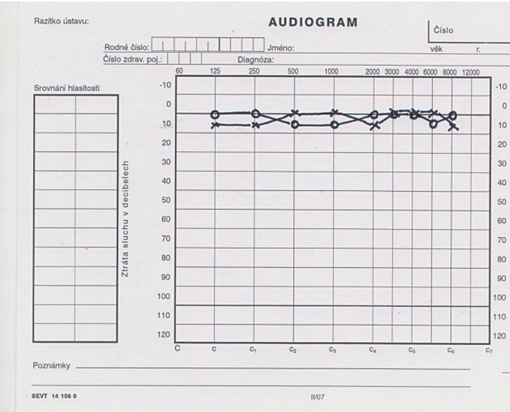 Audiogram normálního sluchu Těžké oboustranné percepční postižení Analogií tónové audiometrie je audiometrie slovní, což je vyšetření rozumění mluveného slova.