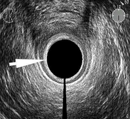 Na EAUS se zobrazuje jako hyperechogenní kružnice přiléhající těsně k povrchu sondy (viz obr. 8). Anální kanál je okolní tkání stlačen a uzavřen a proto během EAUS není viditelný. Obr. 7 M.